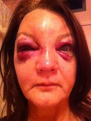 Domestic Violence Photo 1: He asked me to say it was a horse riding accident